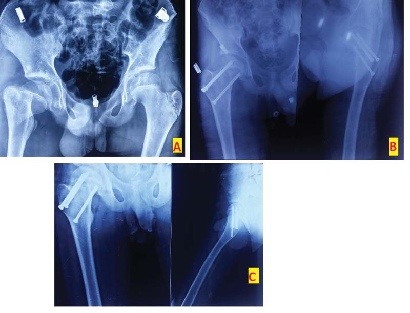 Anteroposterior radiograph of a 5-year-old boy showing a type III fracture (A). The boy needed OR and fixation with screws (B). Final radiograph at 1 year showing union (C).